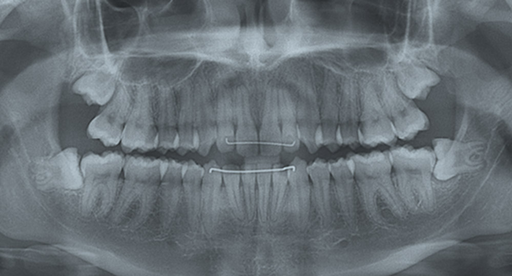 Dentes do Siso – Por que remover?