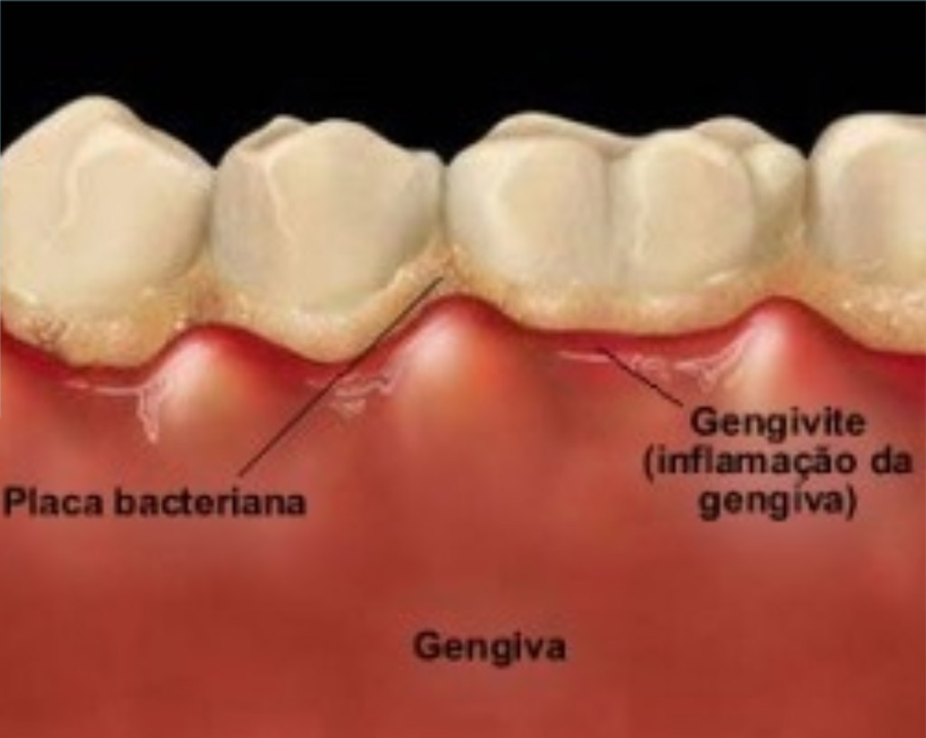 Inter-relação da doença periodontal com problemas sistêmicos