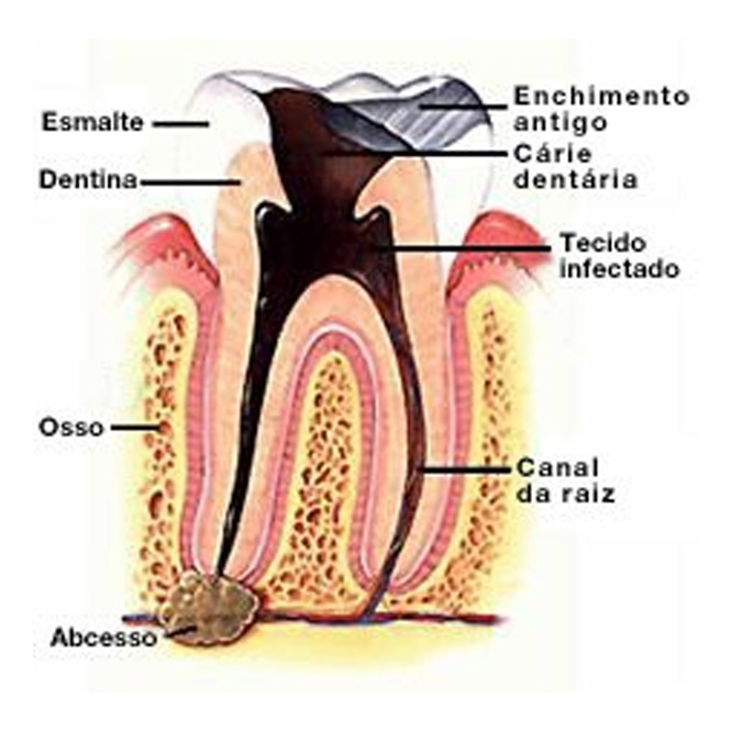 Endodontia (tratamento de canal)